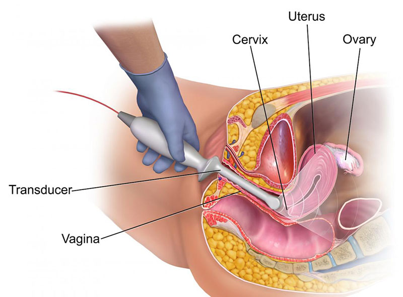 Vaginal Ultrasonography